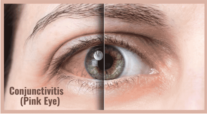 Conjunctivitis (pink eye): Types, Symptoms, Causes, Treatment