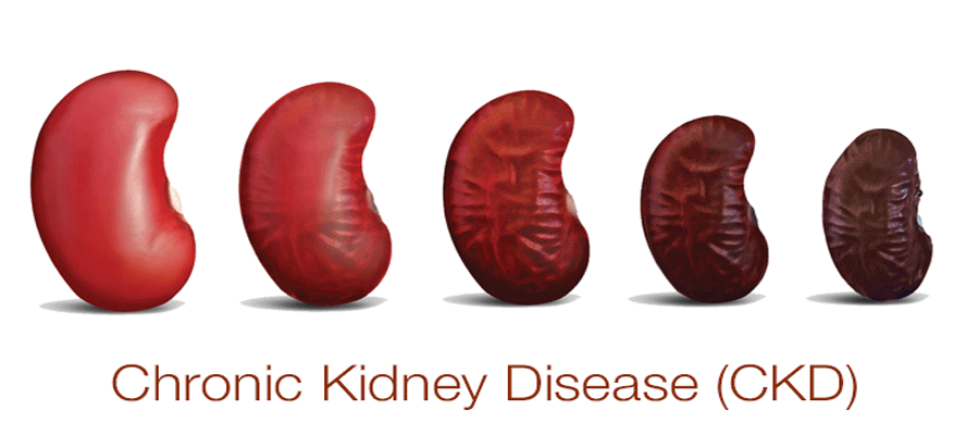 Chronic Kidney Disease - A Silent Killer