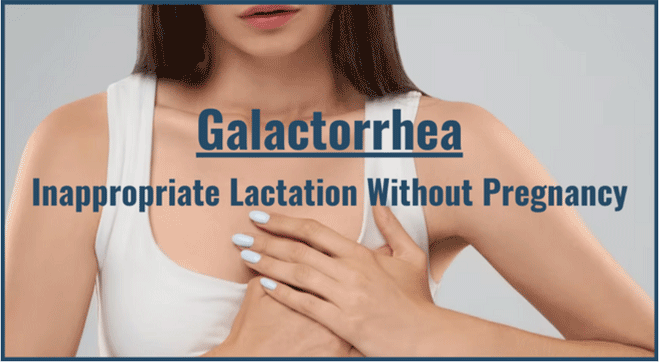 Galactorrhea: Know About Breast Milk Without Pregnancy