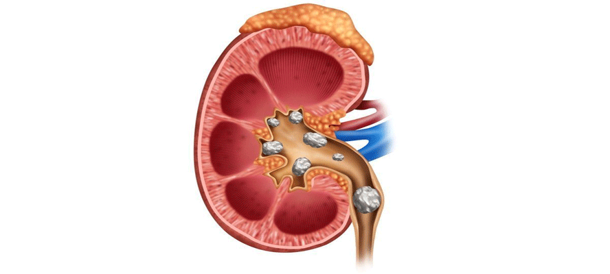 How are kidney stones formed?