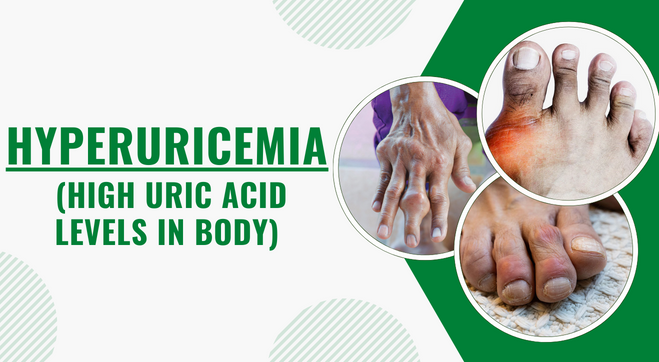 Hyperuricemia (High Uric Acid Levels): Signs, Causes, Risk & More