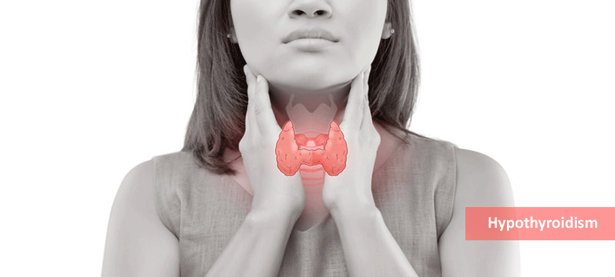 Hypothyroidism Signs Symptoms Causes Treatment Medication