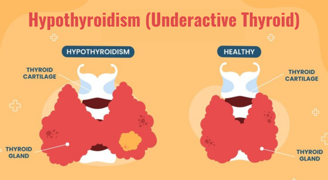 Hypothyroidism:  Causes, Symptoms, Treatment & Medication