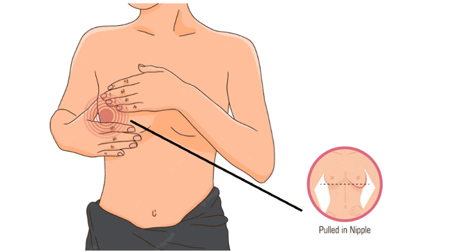 Inverted Nipple: What It Is and When Should You Be Worried