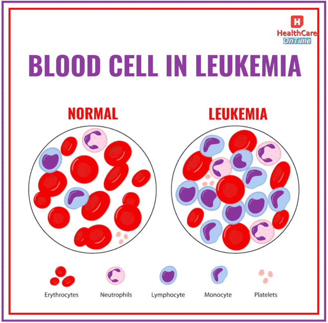Leukemia Outnumbers Healthy Blood Cells