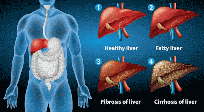 Liver Cirrhosis: Causes, Symptoms, Types, Stages, Treatment