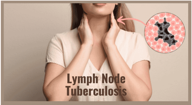 lymph node tuberculosis