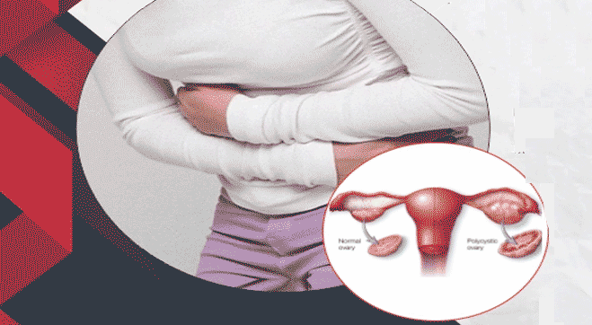 Polycystic Ovarian Syndrome Symptoms Causes Treatment