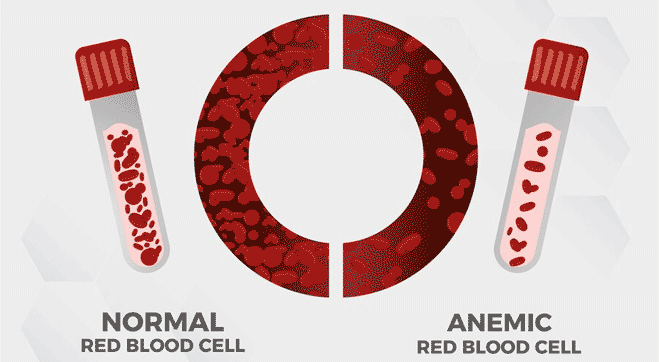 Sickle Cell Anemia: Types, Symptoms, Causes, Treatments