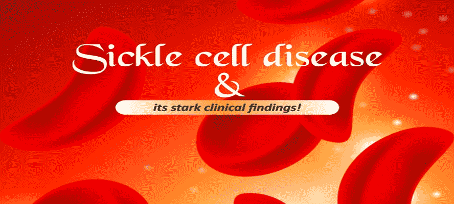 Sickle Cell Disease and Its Stark Clinical Findings