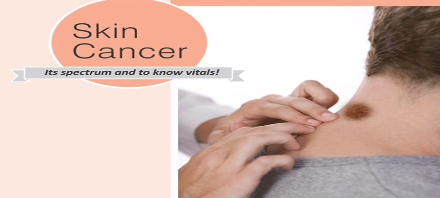 Skin Cancer - Its Spectrum And To Know Vitals