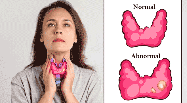 Thyroid Gland Location and Thyroid Dysfunction Disorders