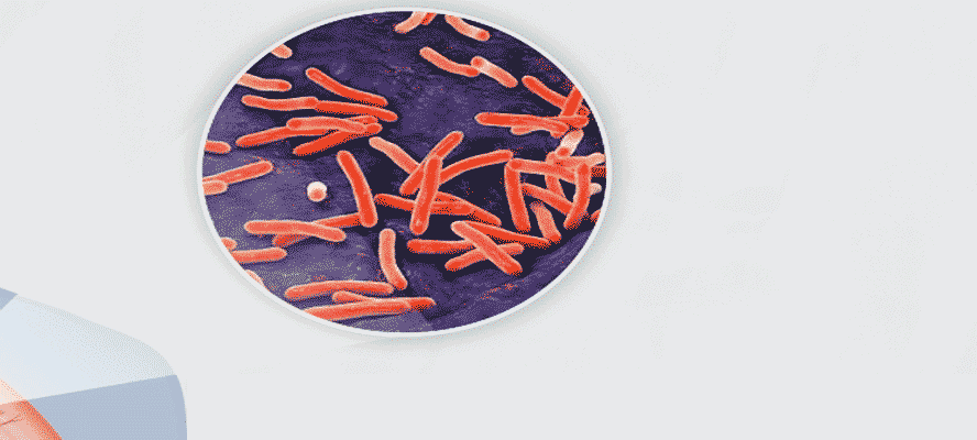 Drug Resistant Tuberculosis - A Real Challenge