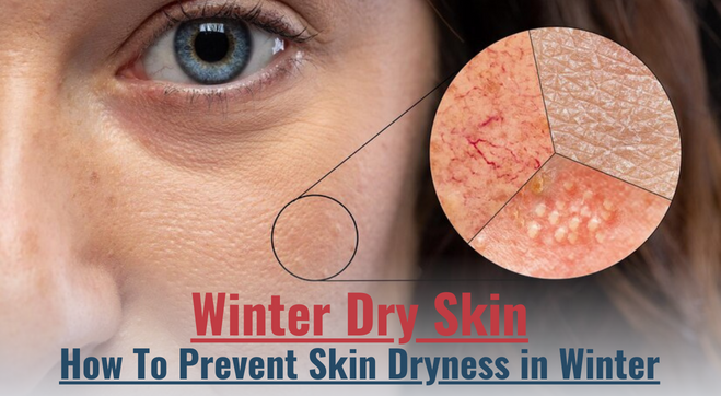 Why Your Skin Gets Dry in Winter: Tips to Prevent Winter Dry Skin