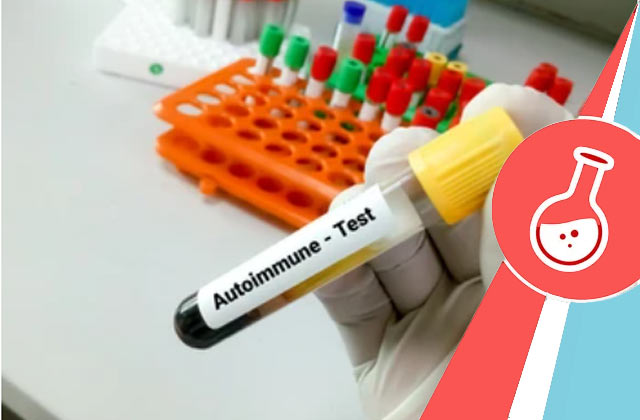 Anti-dsDNA Test