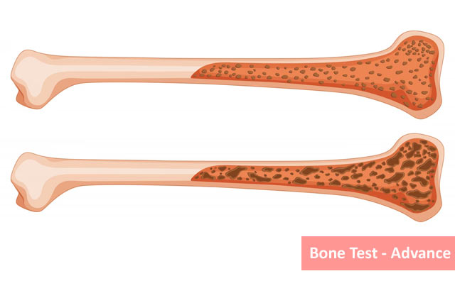 Bone Profile Test - Advance