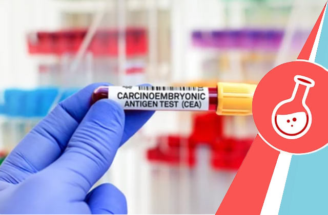 CEA Test (Carcinoembryonic Antigen Test)