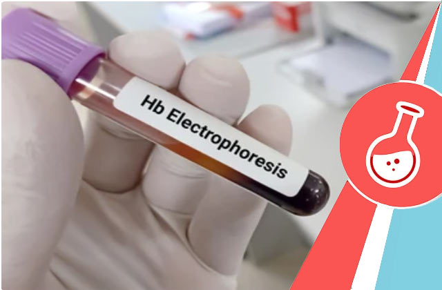 Hb Electrophoresis Test