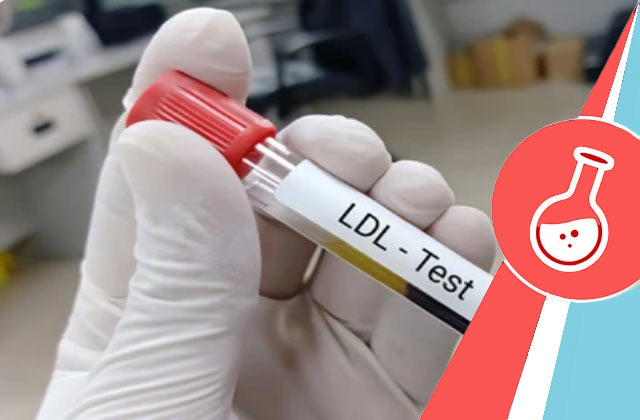 LDL Cholesterol - Direct
