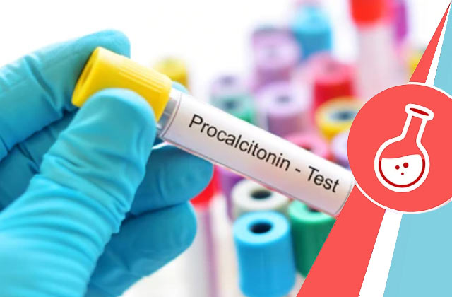 Procalcitonin Test