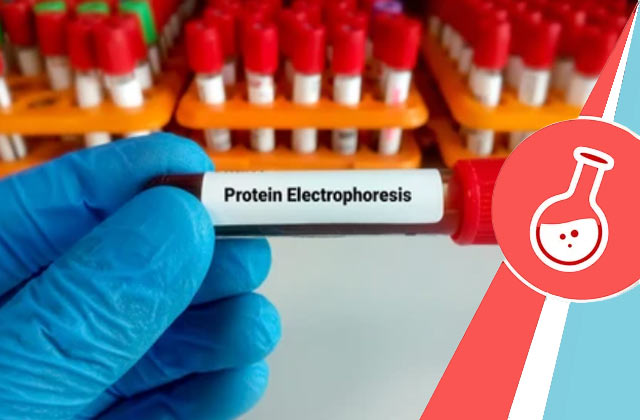 Serum Protein Electrophoresis Test (SPEP Test)