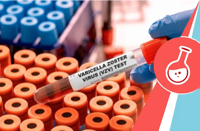Varicella IgG Test (Test For Chickenpox)