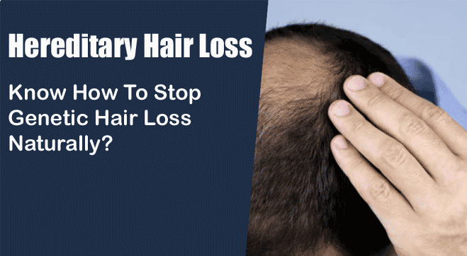 Hereditary Hair Loss Know How To Stop Genetic Hair Loss Naturally 