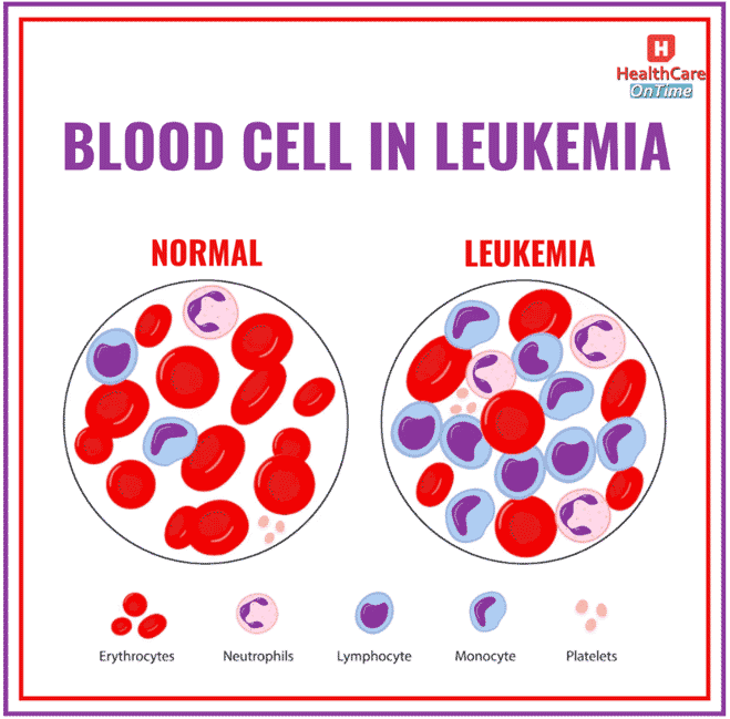 Leukemia Outnumbers Healthy Blood Cells Leukemia Outnumbers Healthy Blood Cells