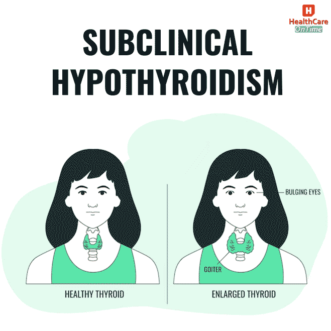subclinical hypothyroidism causes subclinical hypothyroidism causes
