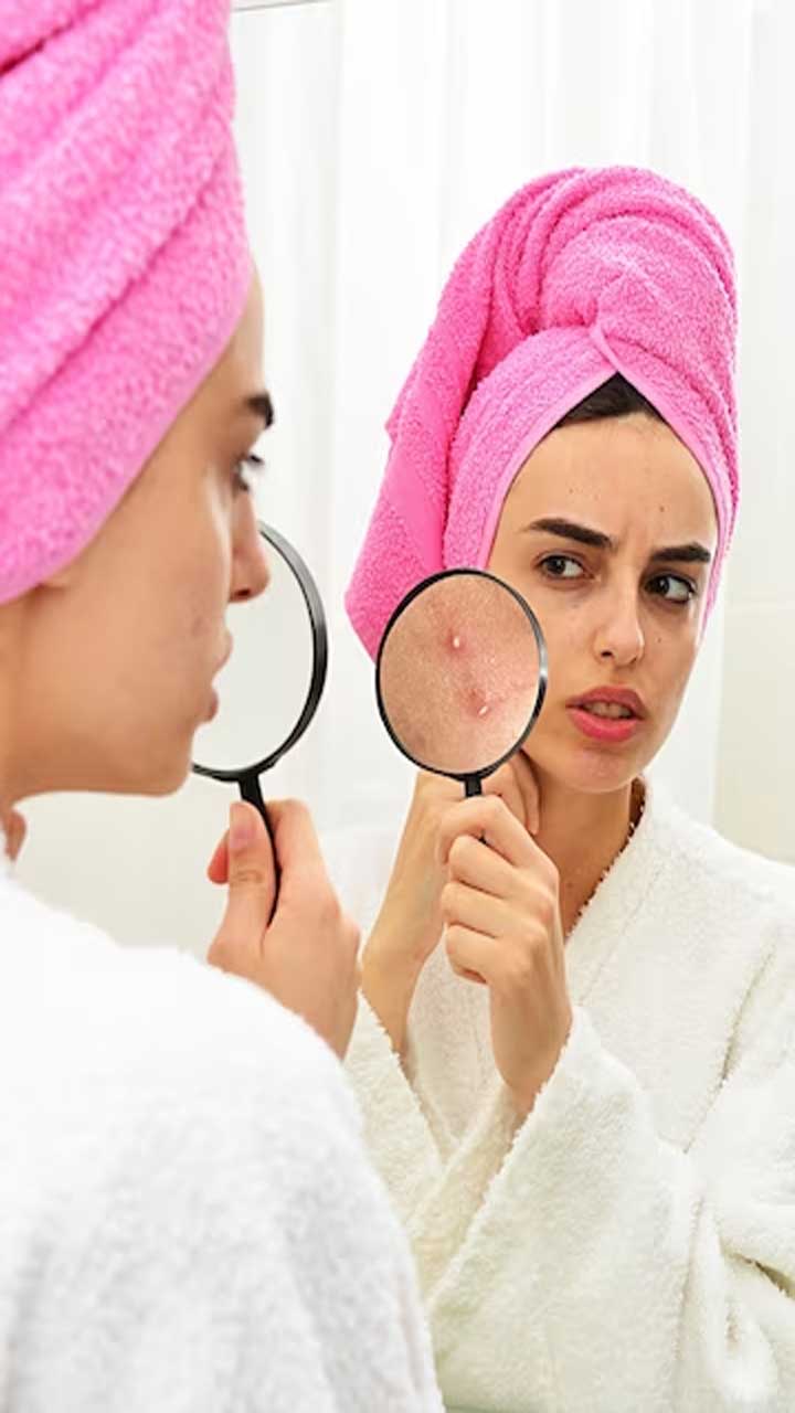 Understanding Acne: 12 Tips for Clearer Skin