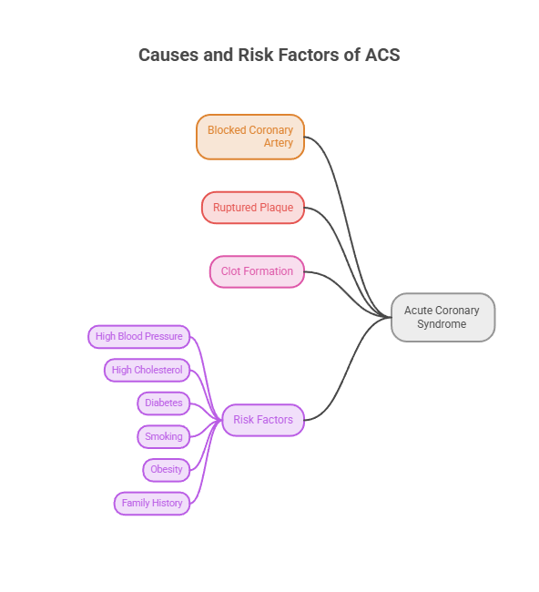 Mind map showing causes and risk factors of Acute Coronary Syndrome, including blocked arteries and health risks.