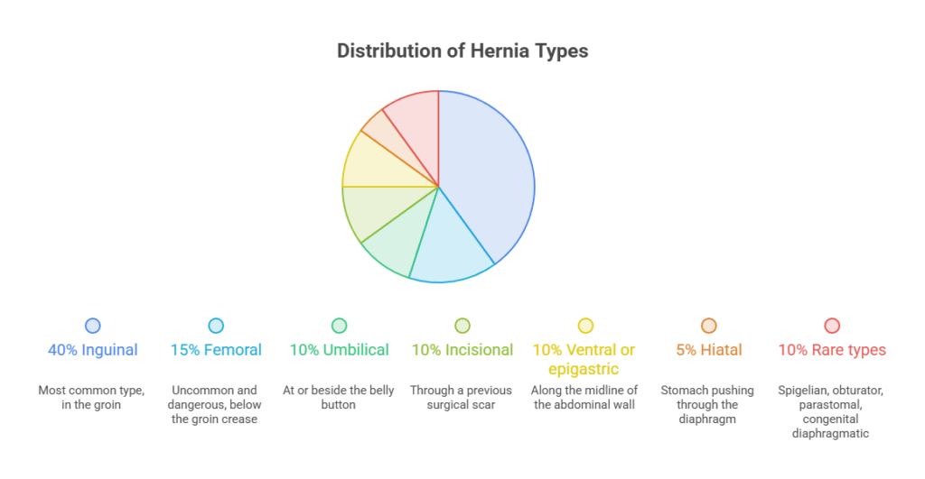 Pie chart showing distribution of hernia types with percentages and descriptions for each type.