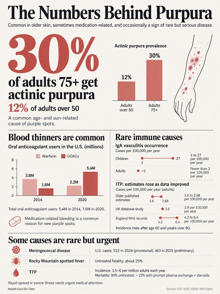 Infographic showing statistics on actinic purpura prevalence and related conditions in adults over 50 and 75+ years old.